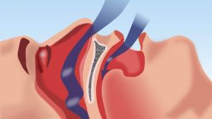 Any loss of smell with rhinoplasty?