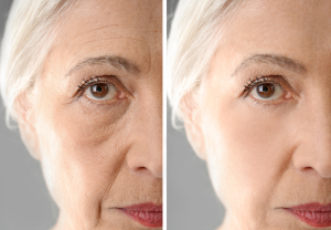 Age limits for rhinoplasty