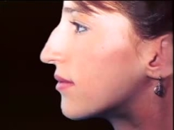 Rhinoplasty